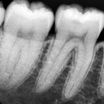 Periapical