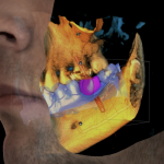 CBCT