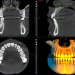 CBCT