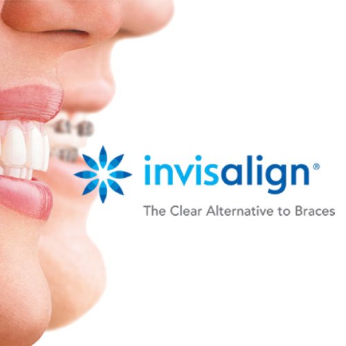 Invisalign 2